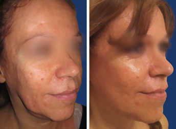 Full Lifting facial feminization surgery before and after