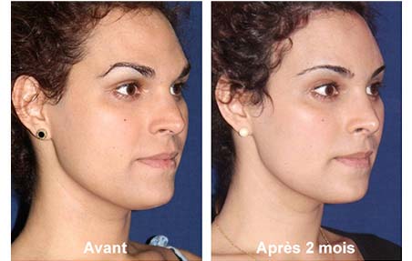 cirurgia de feminização facial