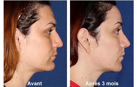 cirurgia de feminização facial