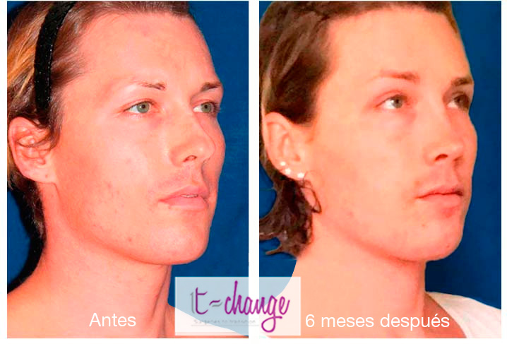 Full facial feminization surgery Dr Javier Rossi before and after