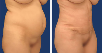 Abdominoplastia (Dermolipectomia abdominaln)