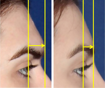 Forehead Contouring