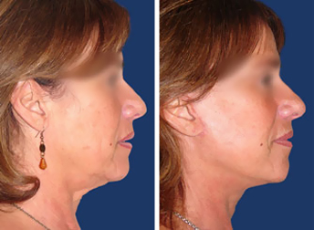 Full Lifting facial feminization surgery before and after