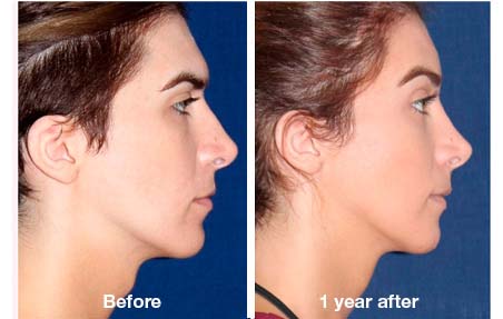 facial feminization surgery