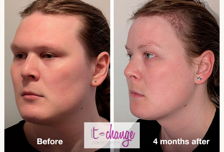 Adam's apple reduction before and after — tracheal shave FFS at T-Change Buenos Aires