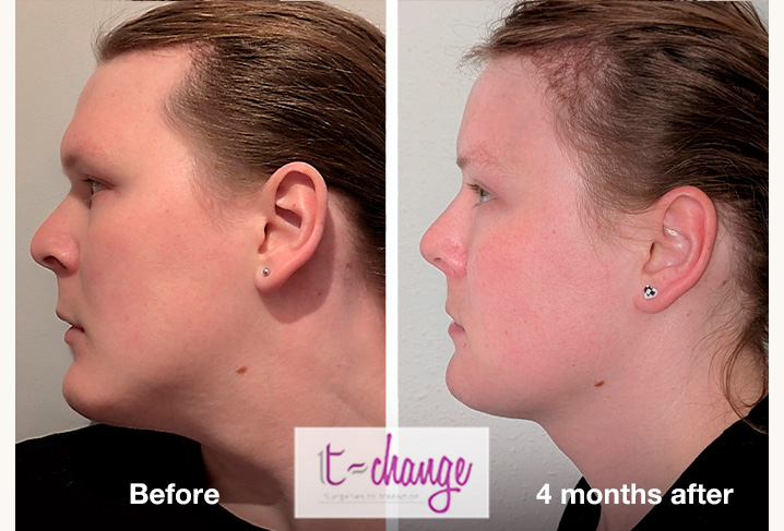 Forehead feminization before and after — brow ridge reduction and forehead contouring at T-Change