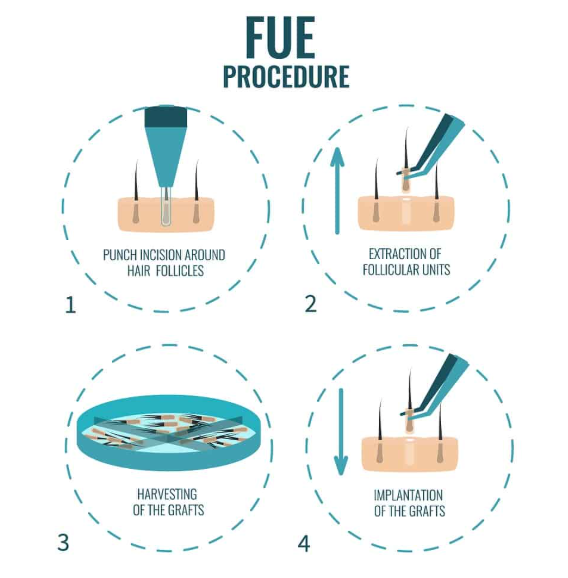 FUE hair transplant — donor area extraction and recipient site implantation at T-Change Buenos Aires