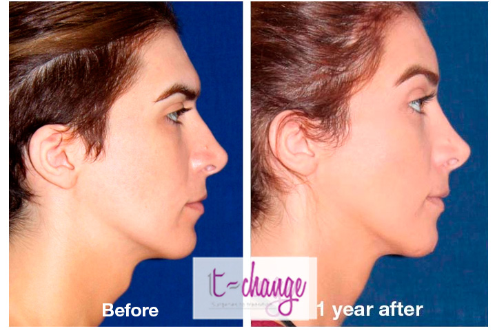 Cheek augmentation before and after — lipofilling and cheek implants FFS at T-Change Buenos Aires