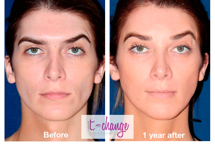 Tracheal shave before and after — Adam's apple removal at T-Change Buenos Aires