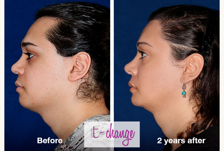 FFS before and after — full facial feminization surgery at T-Change Buenos Aires