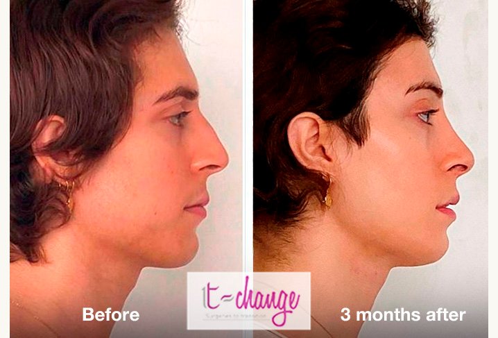 FFS before and after — Forehead, Nose and Jaw feminization at T-Change Buenos Aires