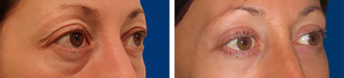 Blepharoplasty before and after — eyelid surgery results at T-Change