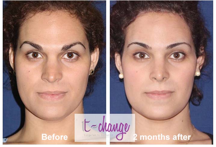 Brow lift surgery before and after — standalone eyebrow lift at T-Change Buenos Aires