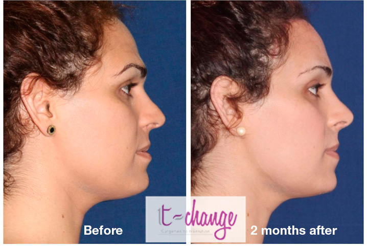 Brow lift before and after — eyebrow feminization surgery at T-Change Buenos Aires
