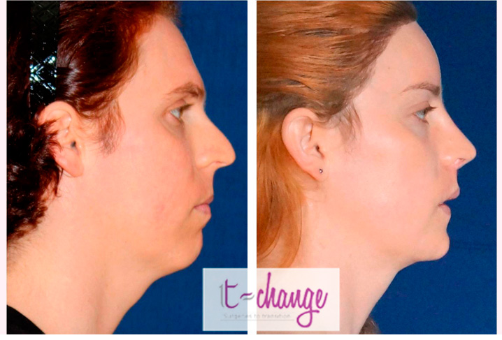 Cheek augmentation before and after — cheek implants for facial feminization at T-Change Buenos Aires