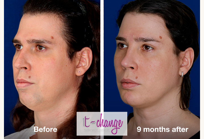 Chin feminization before and after — sliding genioplasty at T-Change Buenos Aires