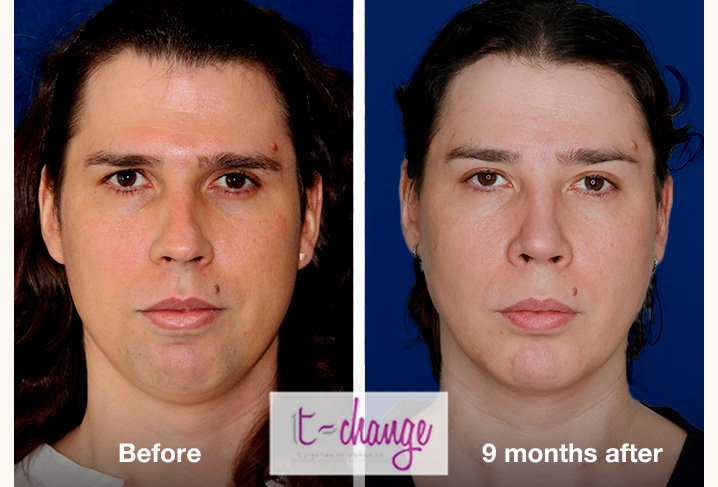 Chin contouring before and after — chin feminization FFS at T-Change Buenos Aires