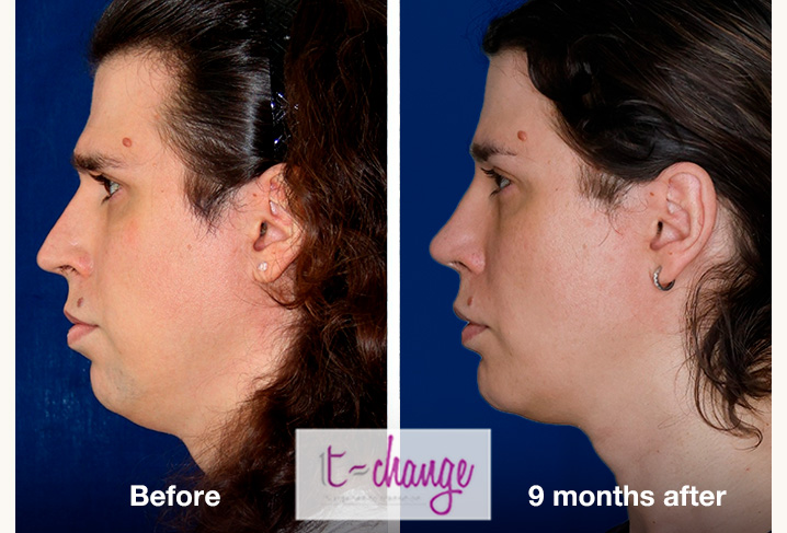 Chin reduction before and after — chin feminization surgery at T-Change Buenos Aires