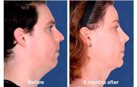 FFS before and after — Jaw, Chin and Lip feminization at T-Change Buenos Aires