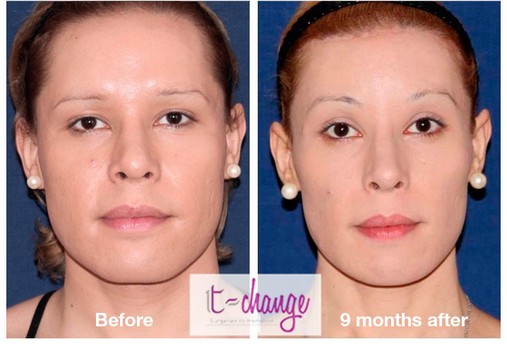 Jaw reduction and chin feminization before and after — FFS at T-Change Buenos Aires