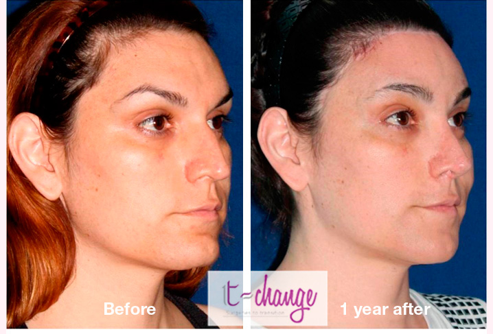 Jaw contouring before and after — mandibuloplasty FFS at T-Change Buenos Aires