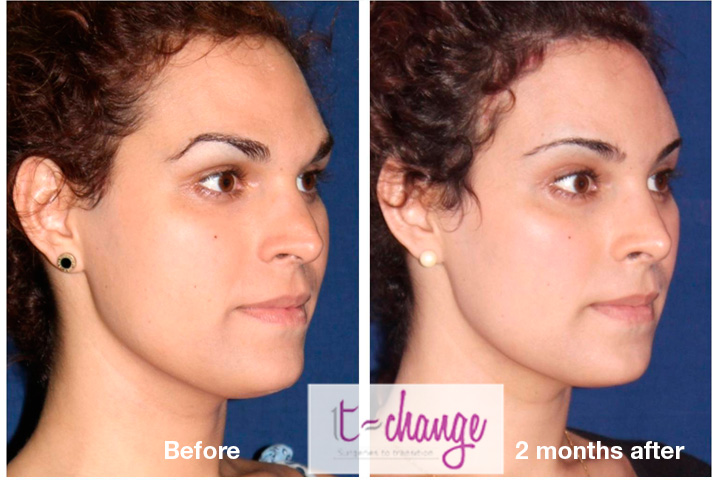 Jaw reduction before and after — mandible contouring for facial feminization at T-Change Buenos Aires