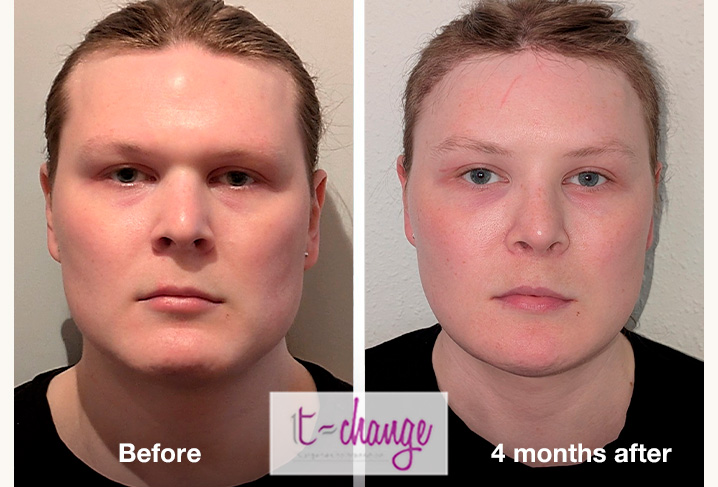 FFS before and after — jaw chin and lip feminization at T-Change Buenos Aires
