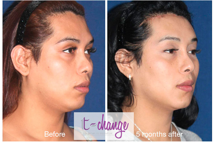 FFS before and after — forehead and brow lift feminization at T-Change Buenos Aires