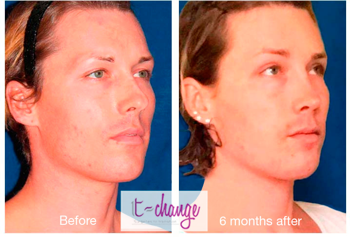 Adam's apple feminization before and after — thyroid cartilage reduction at T-Change Buenos Aires