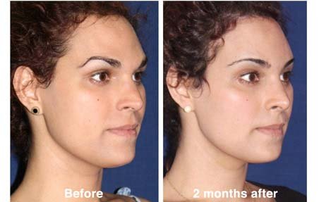 FFS before and after — Forehead and Brow Lift feminization at T-Change Buenos Aires