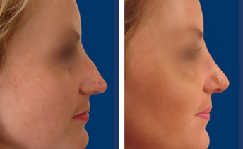 Feminizing rhinoplasty before and after — bridge and tip refinement at T-Change Buenos Aires
