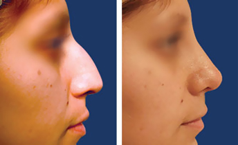 Feminizing rhinoplasty before and after — nose feminization at T-Change Buenos Aires