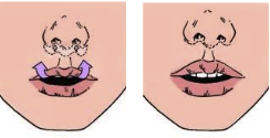 Upper lip lift diagram — bull horn technique showing skin removal below the nose at T-Change Buenos Aires