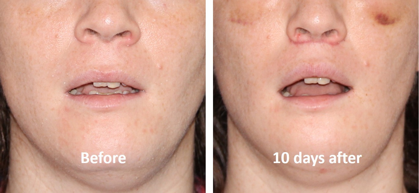 Upper lip feminization before and after — lip lift combined FFS at T-Change Buenos Aires