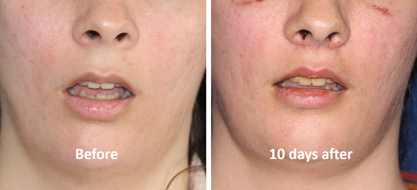 Upper lip lift before and after — philtrum shortening FFS at T-Change Buenos Aires