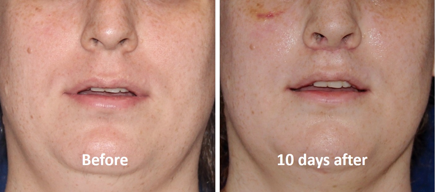 Upper lip surgery before and after — bull horn lip lift at T-Change Buenos Aires