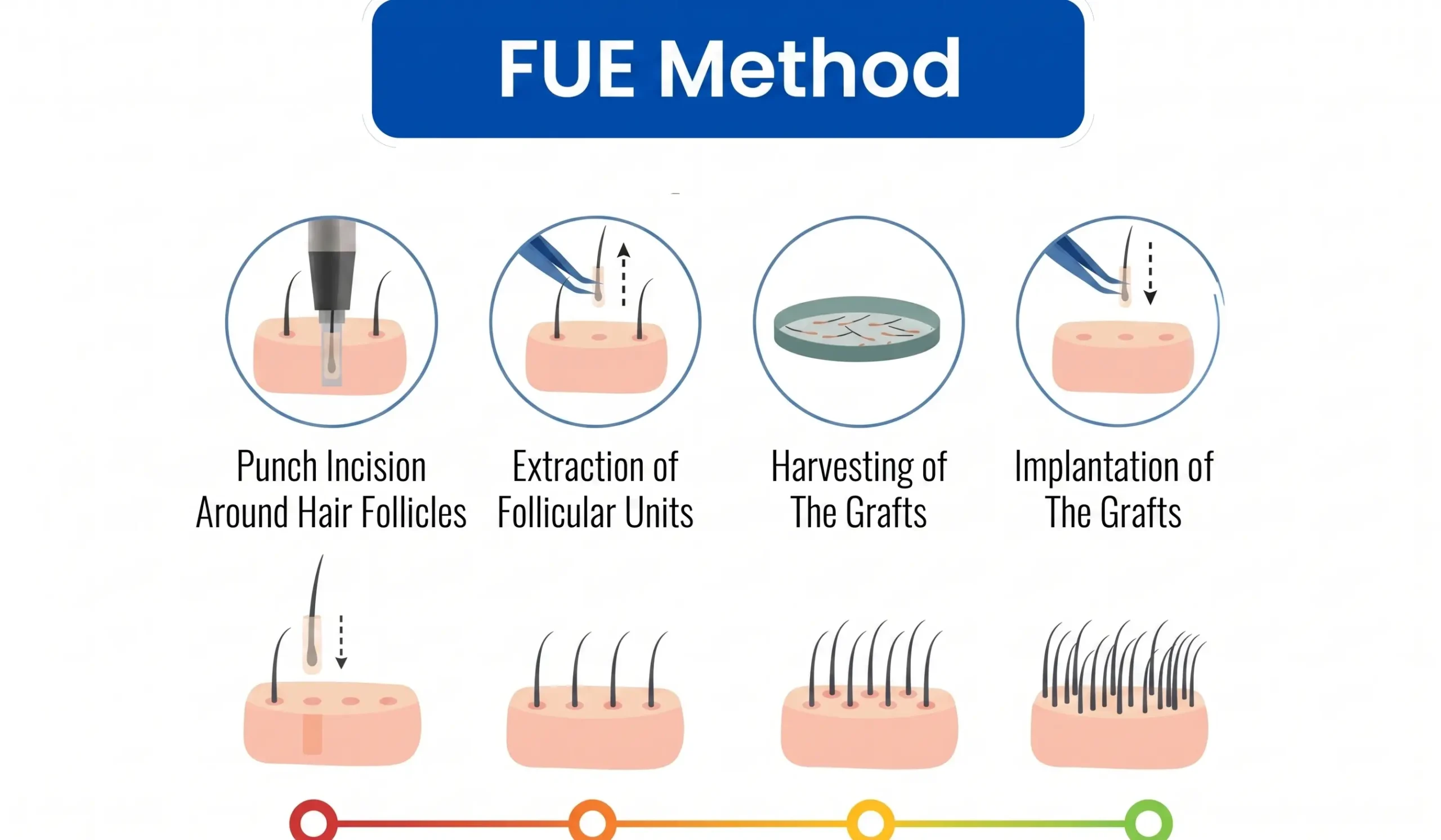 FUE hair transplant graft extraction — donor area preparation at T-Change Buenos Aires