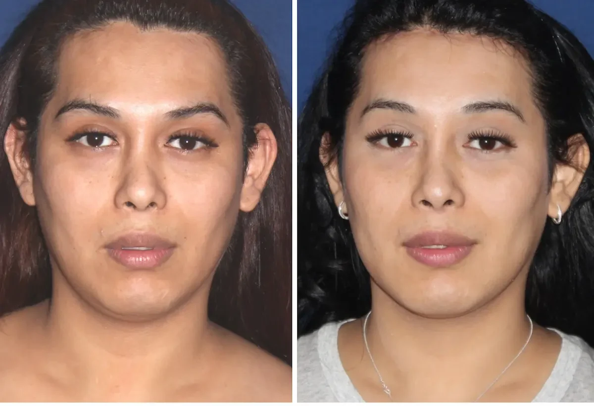 FFS before and after — case 15 — frontal 5 months — T-Change